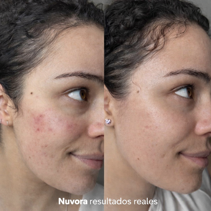 GlowLift LED – Piel más firme sin Botox
