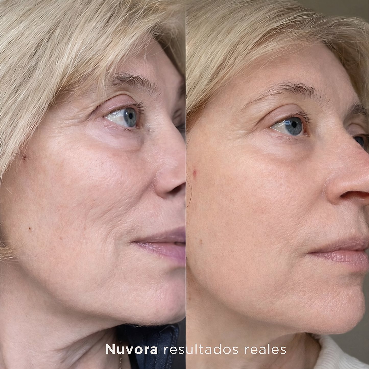 GlowLift LED – Piel más firme sin Botox